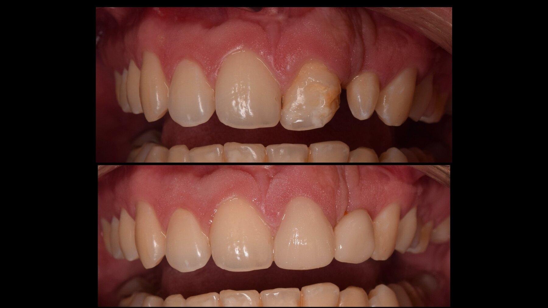 Antes y después intraoral de rehabilitación estética en paciente con secuela de fisura labiopalatina