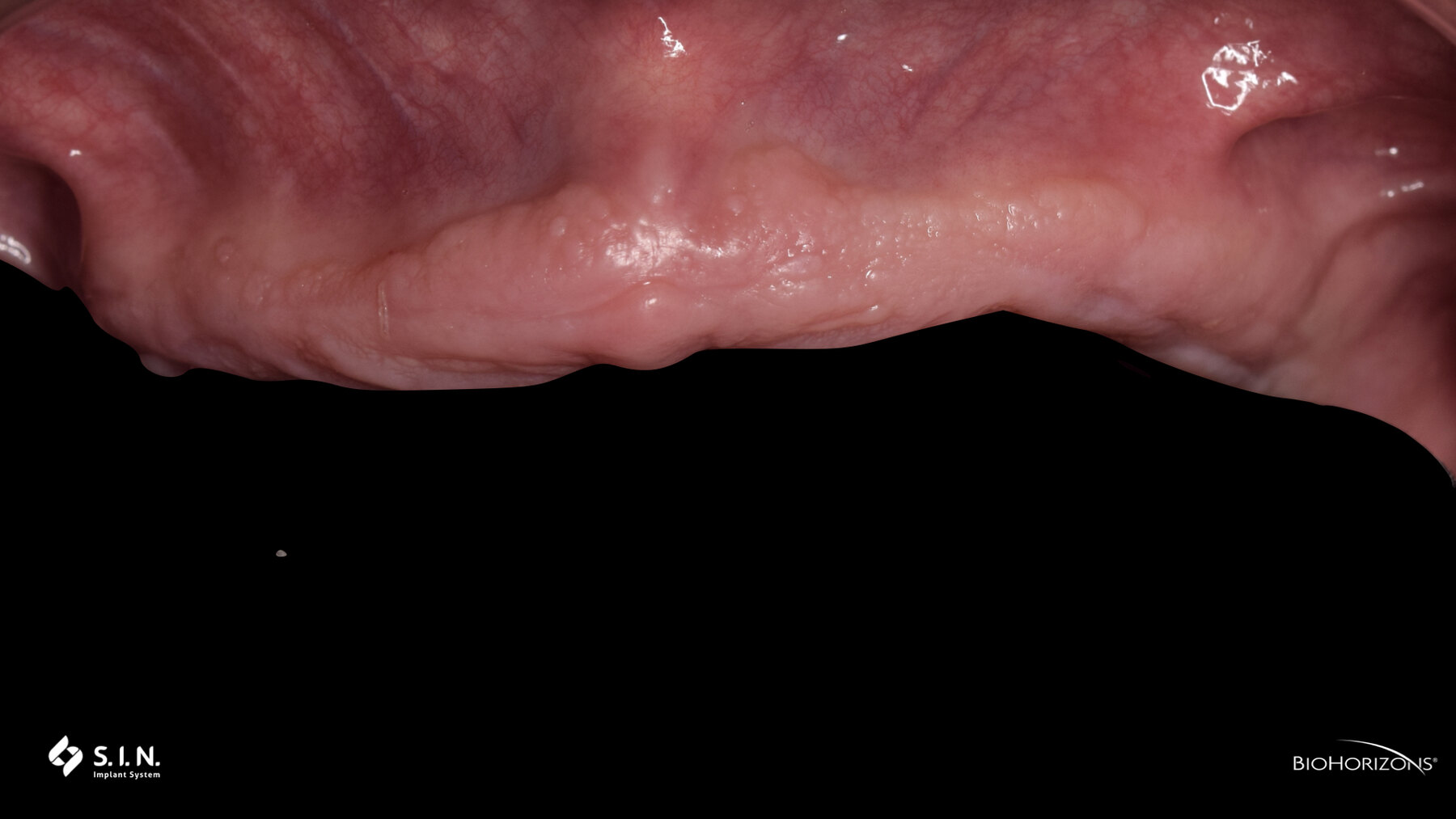 Evaluación intraoral del reborde