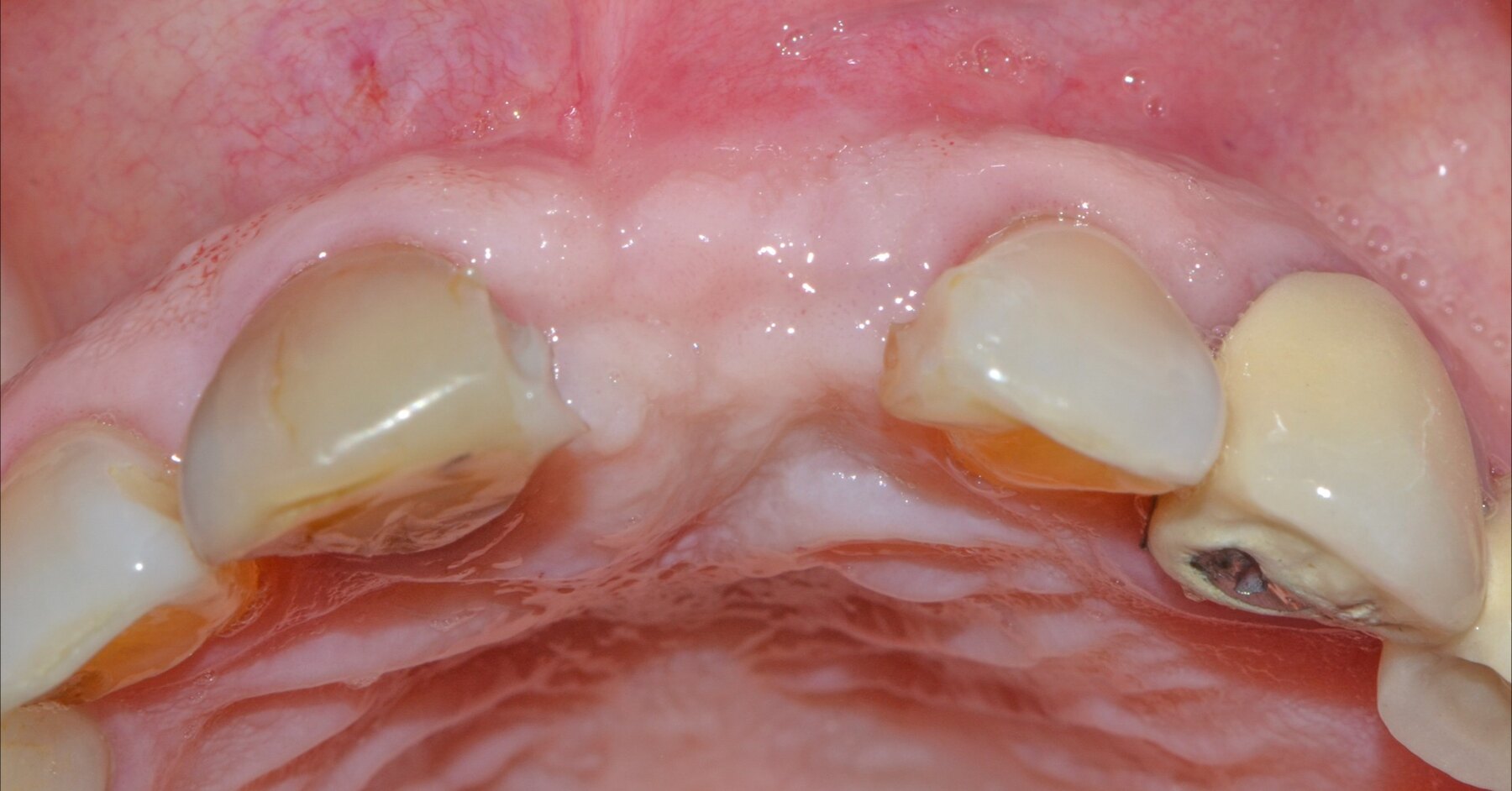 Situación inicial del tejido periimplantario